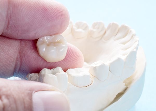 Bellefontefamilydentistry Crown